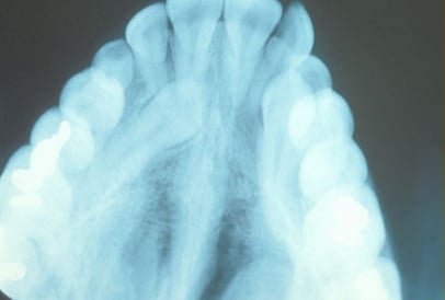 impacted-tooth1-full