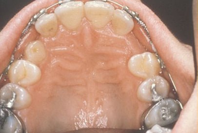 impacted-tooth2-full
