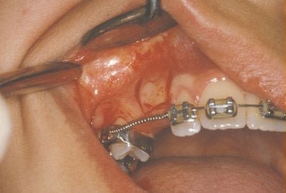 impacted-tooth3-full