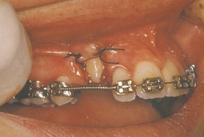 impacted-tooth4-full