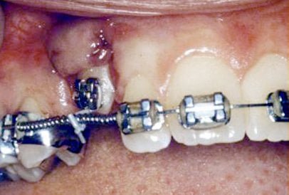 impacted-tooth5-full