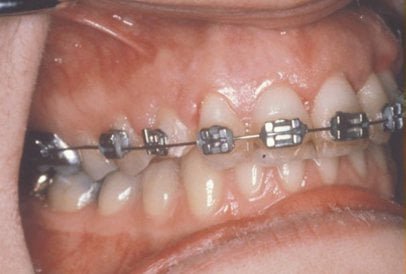 impacted-tooth6-full