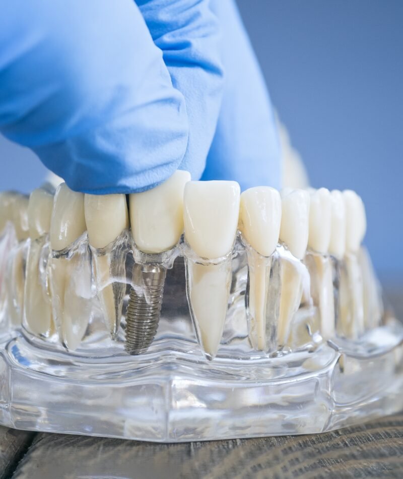 Dental Implants